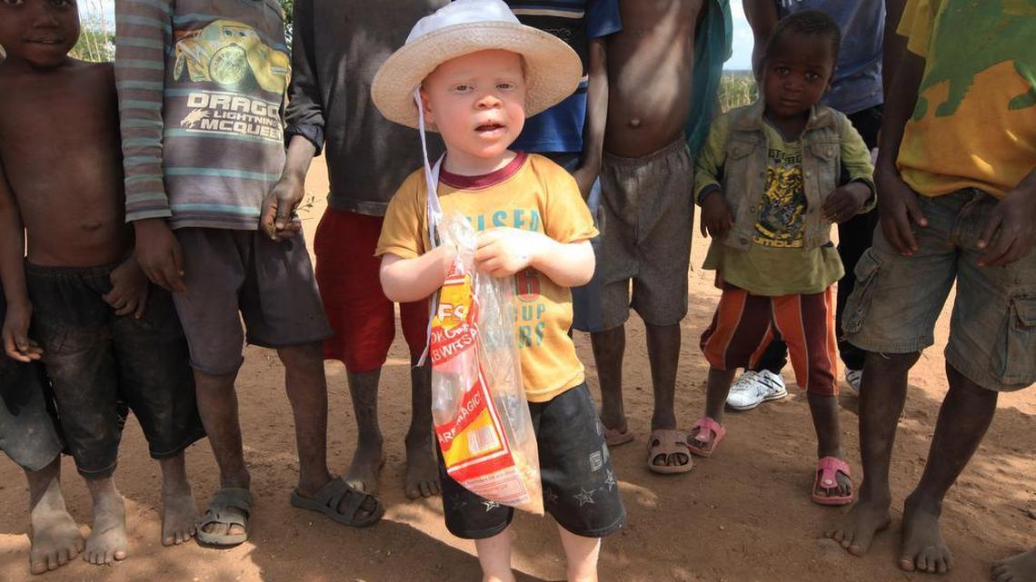 Cassim Jaffalie, 3, is seen with his friends at their family home on May, 23, 2016, in Machinga, about 200 kilometers north east of Blantyre Malawi. His father, Razik Jaffalie, gave up his work as a bicycle taxi operator to protect his son in a country where there has been an increase in albinism attacks. At least 18 Albino people have been killed in Malawi in a “steep upsurge in killings” since November 2014, and five others have been abducted and remain missing, a new Amnesty International report released Tuesday, June 7, 2016 says.
