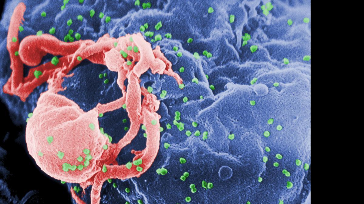 
This undated photo provided by the Centers for Disease Control and Prevention shows a scanning electron micrograph of multiple round bumps of the HIV-1 virus on a cell surface. An 18-year-old French woman born with the AIDS virus has had her infection under control and nearly undetectable despite stopping treatment 12 years ago, an unprecedented remission, doctors are reporting, Monday, July 20, 2015. 
