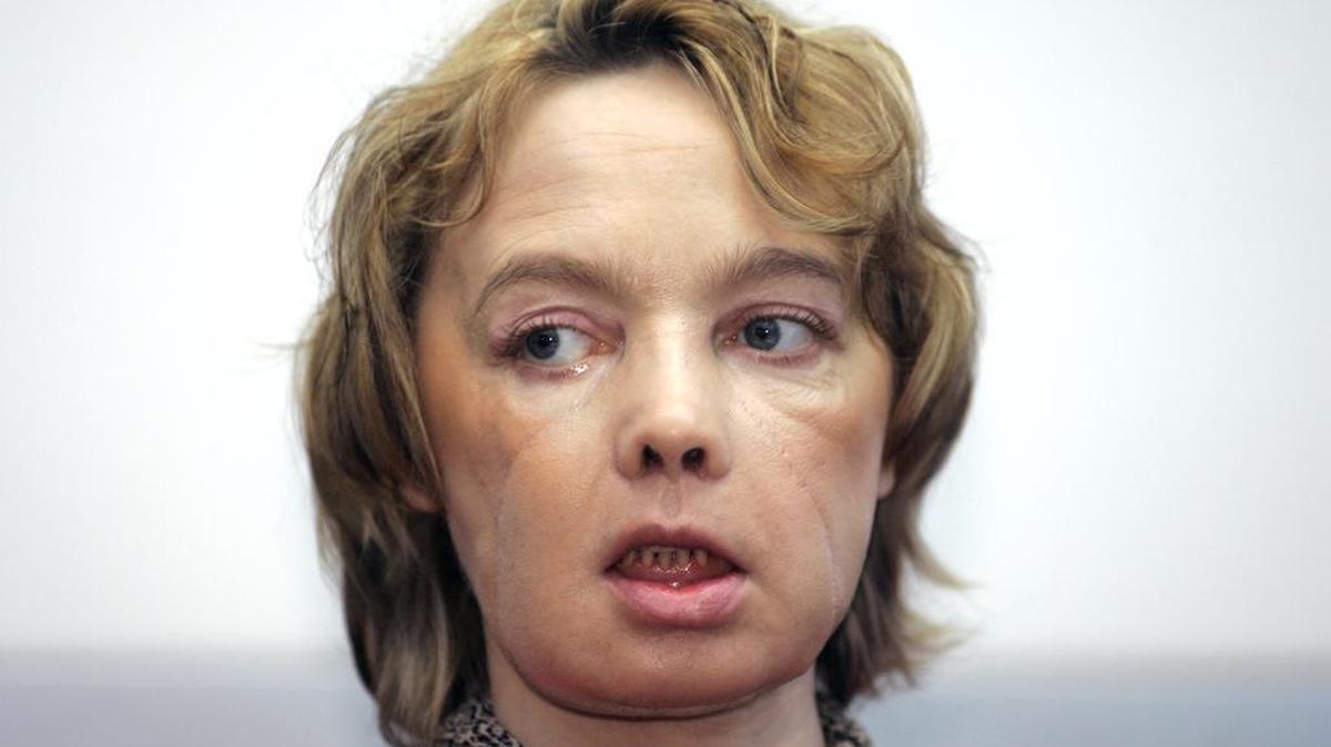 Isabelle Dinoire, the woman who received the world’s first partial face transplant with a new nose, chin and mouth, in an operation on Nov. 27, 2005, addresses reporters during her first press conference since the transplant at the Amiens hospital, northern France, on Feb. 6, 2006. She had been mauled by a dog, leaving her with severe facial injuries that her doctors said made it difficult for her to speak and eat. Dinoire has died, 11 years after surgery that set the stage for dozens of other transplants around the world.