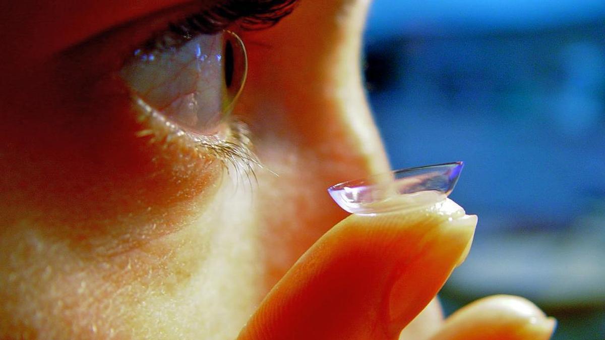A 42-year-old woman had a cyst containing a hard contact lens removed from her eye. Doctors determined the lens was 28 years old and had migrated to her upper eye when she was hit with a shuttlecock when she was 14.