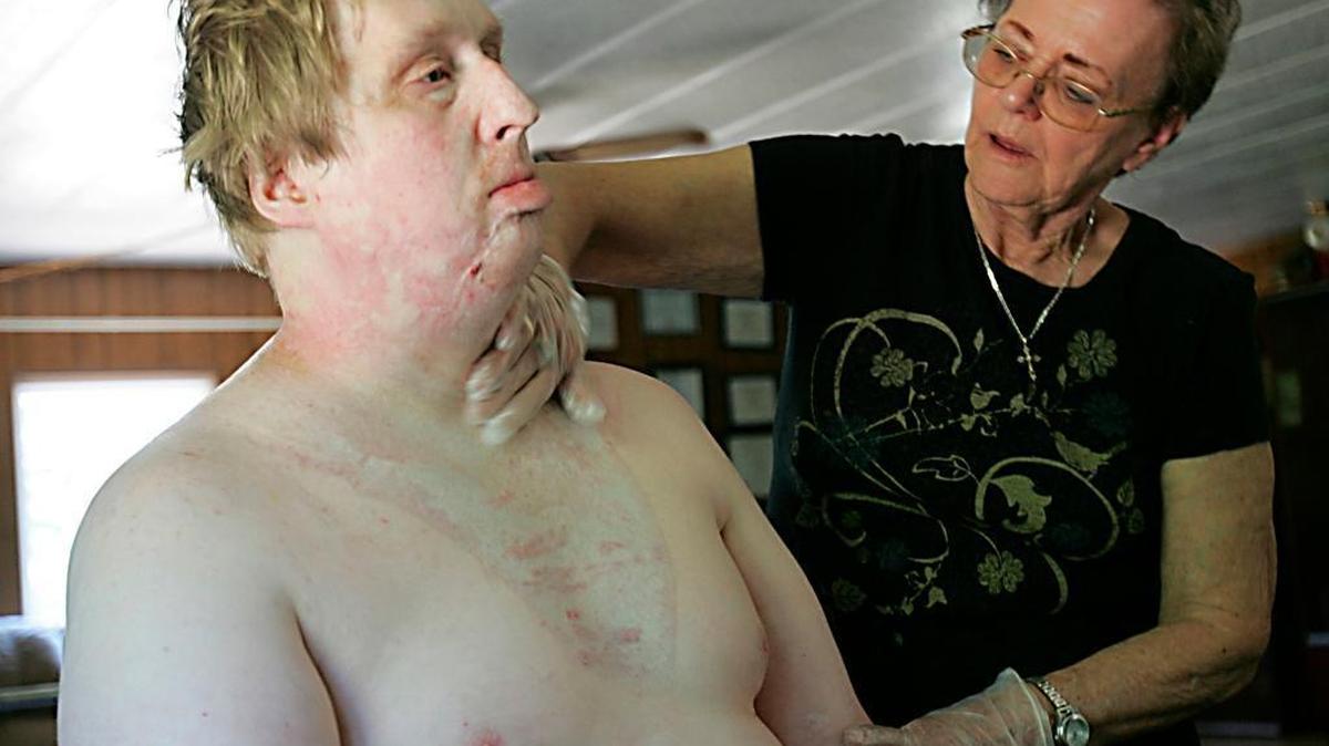 On Aug. 4, 2012, Judy Harris of Port Orchard, Wash., cares for a live-in family friend, David Hoffman, who suffered severe burns in a laundry dryer explosion. Medicaid pays Harris to provide just over two hours of care each day. But Medicaid funding for home-care services could be in jeopardy under the GOP health care bill moving through Congress.